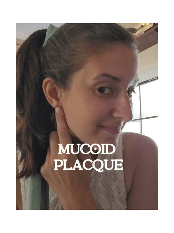 Mucoid … WHAT?